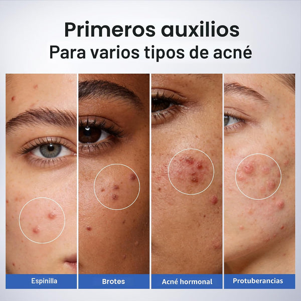 Loción Secante Antiacné